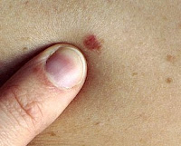 skin moles cancer