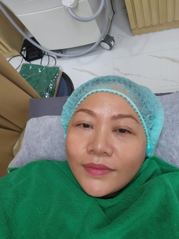 Pengalaman Treatment DNA Salmon di ZAP Clinic DP Mall Semarang