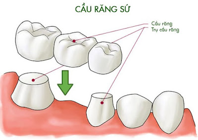 Trồng răng giả với cầu răng sứ