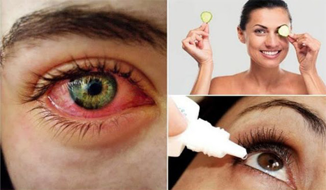 Traitements naturels pour les yeux secs (la sécheresse oculaire)