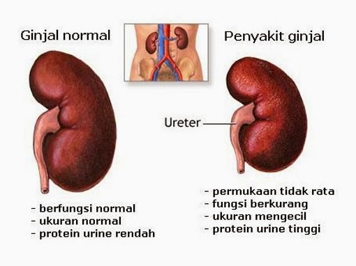 http://obatisakitginjal.blogspot.com/