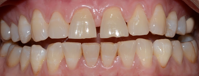 Spacing Between Upper Front Teeth