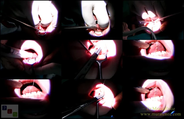 Dil bağı çıkarılması - Lingual frenektomi - Dil bağı tedavisi - Dil altı bağı kesilmesi - Dil bağı ameliyatı - Dil bağı operasyonu - Lingual frenectomy - Dil altı bağı tedavisi - Dil bağı çıkarılması işlemi fiyatı - Dil bağı çıkarılması işlemi nasıl yapılır? - Dil bağı çıkarılması (lingual frenektomi) nedir? - Kansız dil bağı ameliyatı – Thermal welding ile dil bağı ameliyatı -  Tongue tie release surgery with thermal welding device - Lingual frenectomy operation with thermal welding device - Bloodless and knifeless tongue tie release surgery - Bloodless lingual frenectomy with with thermal welding – Tongue tie treatment in İstanbul, Turkey