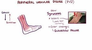 Peripheral Vascular Disease Pictures