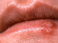 Cold Sores in Children: About the Herpes Simplex Virus