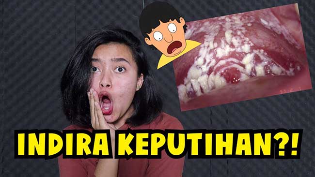 Penyebab Munculnya Keputihan