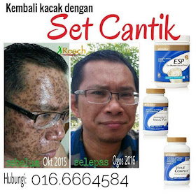 BAGAIMANA MENGHILANGKAN KESAN PARUT DEGIL CHIKEN POX