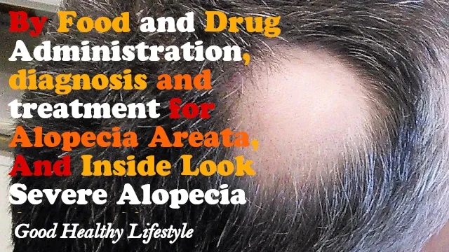 Alopecia Areata Treatment, Symptoms and Causes of Hair Loss