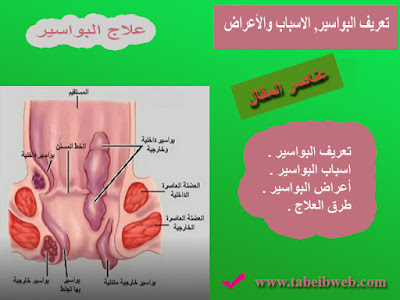 تعريف البواسير, الاسباب والأعراض