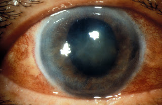 Eye with acute glaucoma attack