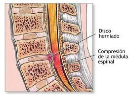 Hernia de Disco