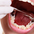  Lấy tủy răng có tốt không