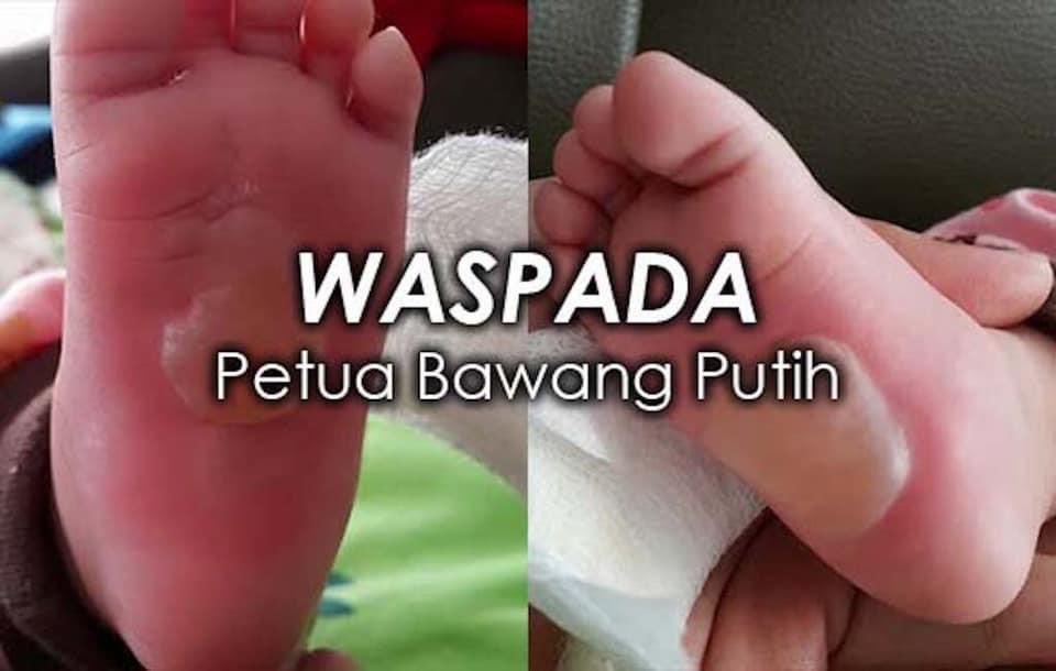 doktor nasihat waspada petua bawang putih bayi