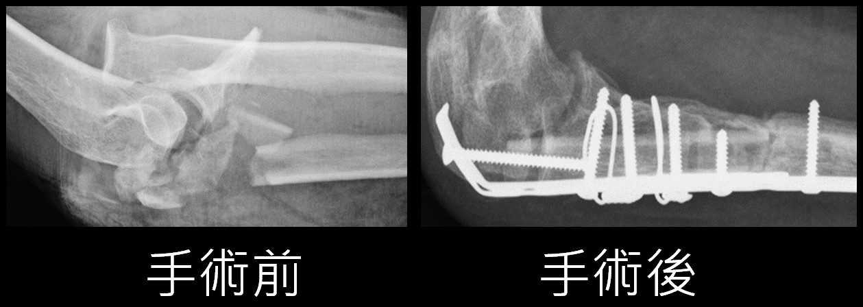 楊鎮源醫師 手肘關節慘遭機器輾碎自體腓骨移植成功重建