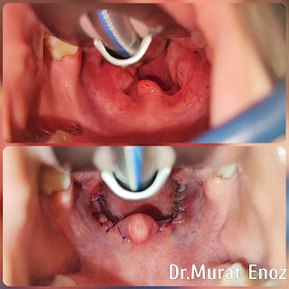 Tonsillectomy operation,Recovery after tonsillectomy,Autoimmune disease,Tonsil removal techniques,