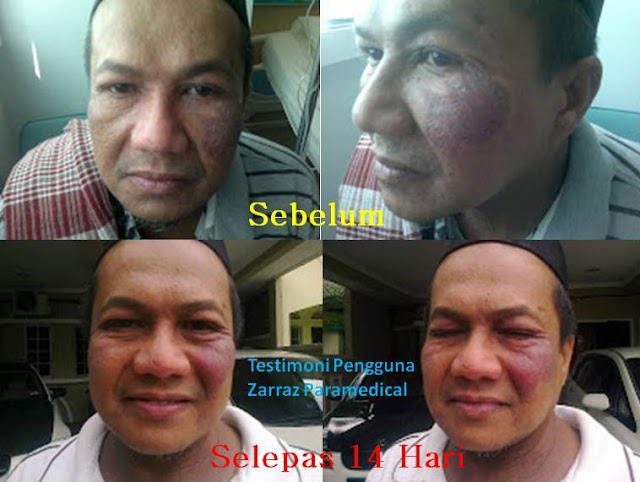 Testimoni ~ Zarraz Paramedical