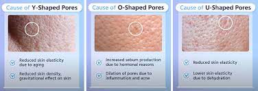 WHAT ARE OPEN PORES? TYPES, CAUSES, WHAT DIFFERENCE BETWEEN OPEN PORE AND CLOGGED PORES? HOW CAN YOU TELL IF YOU HAVE OPEN PORES, TREATMENT