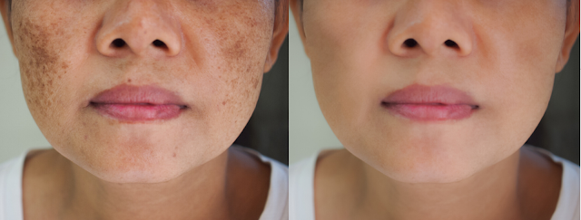 What Medical Treatment can Get you rid of Melasma?