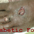 Diabetic Foot Infection: A Major and Dangerous Complication of Diabetes Mellitus