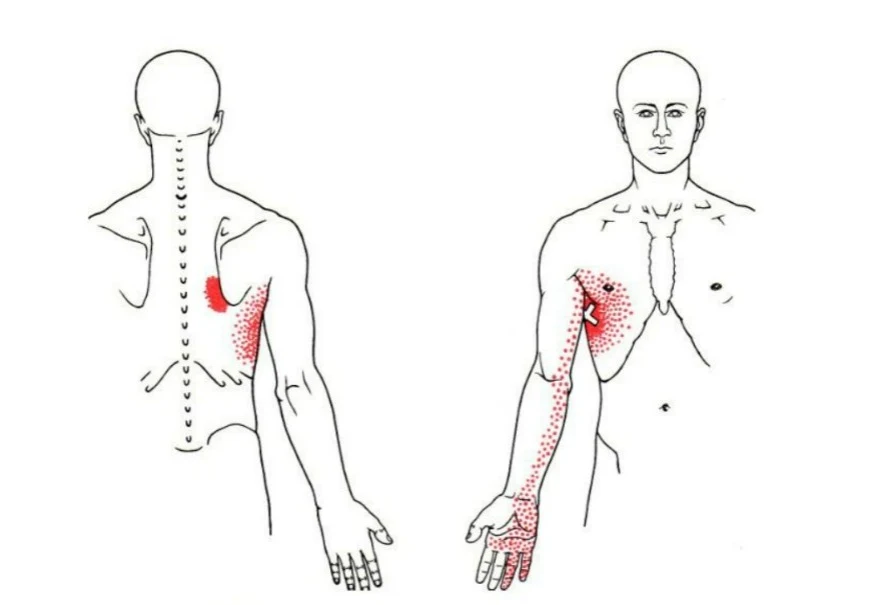 Dolor en el pecho - serrato anterior - mcdevservices spa