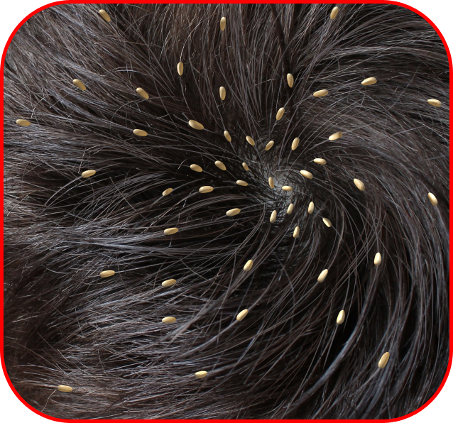 With these 10 remedies you can get rid of dandruff