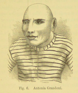 A pencil portrait of Antonia Grandoni taken from Dr Ireland's book. She is in three-quarter profile, her head is bald, and she is wearing a black and white stripy shirt like a prison uniform.