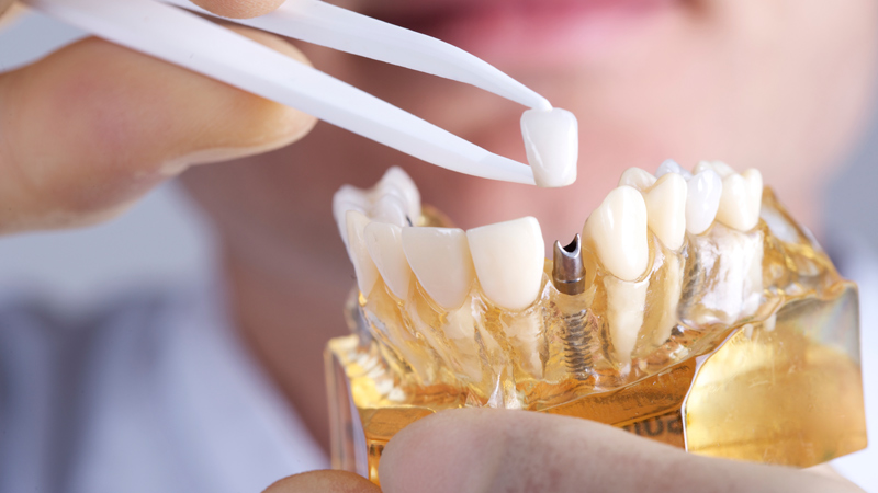 Implant Dentistry in Pennsylvania