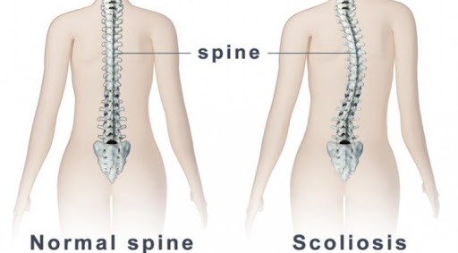 pengalaman terapi skoliosis (dewasa)