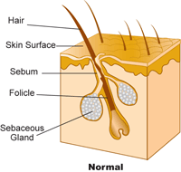 What_Causes_Back_Acne_and_How_Can_You_Get_Rid_of_It