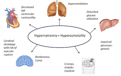 hypernatremia