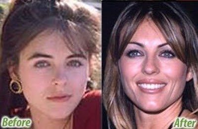 celebrity plastic surgery