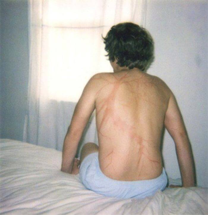 18 Lightning Strike Survivors Reveal Their Shocking Markings