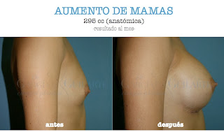 aumento_pecho_mamas_madrid_cirujano_plastico