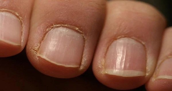 Your Nails Immediately See A Doctor!