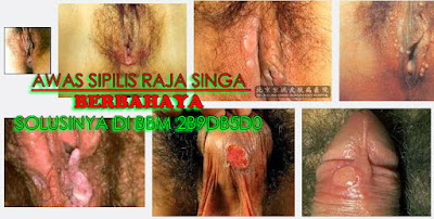 TANAMAN OBAT PENYAKIT SIPILIS