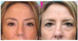 how is the laparoscopic brow lift