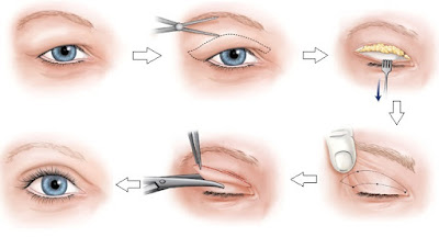 Đôi mắt trẻ trung nhờ phẫu thuật cắt da thừa mí mắt 3