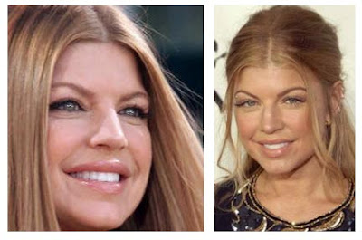 Fergie After Plastic Surgery