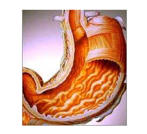 Antral Gastritis