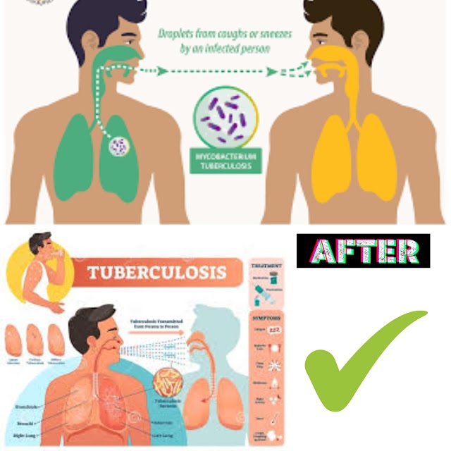 How tests are done to diagnose tuberculosis? 