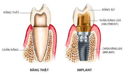 Quy trình cấy ghép implant