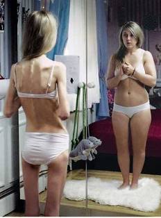 Bulimia y anorexia: mitos y realidades