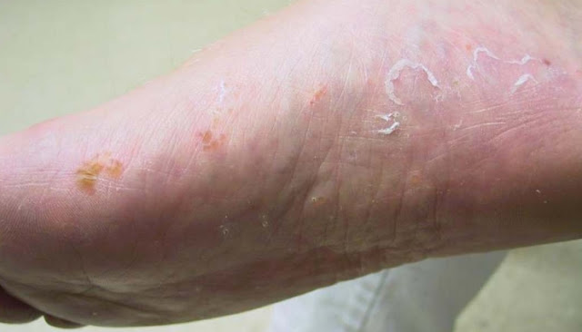 Tinea_pedis_-_Why_constant_treatment_is_important