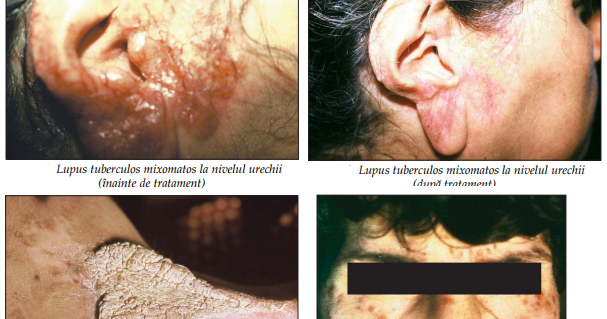 Medicine Conspectus Tuberculoza Cutanată Semiologie Dermatologică