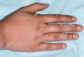 common warts