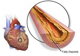 Diagnosis Of Coronary Heart Disease