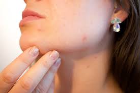 Pimple marks remove tips in hindi