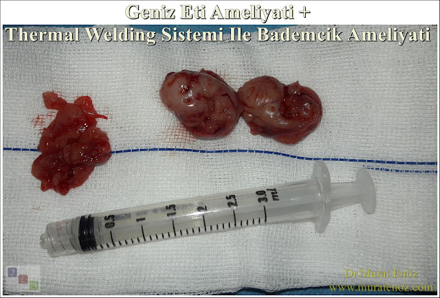 Before and After Photos For Tonsillectomy in Istanbul - Tonsil Removal in Istanbul - Bloodless Tonsillectomy - Thermal Welding Tonsillectomy