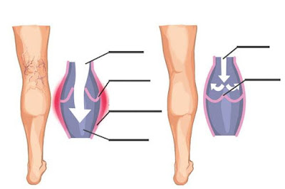 ما هو السبب الذي يؤدي الى حدوث الدوالي ؟؟؟ وما هو العلاج الطبيعي لها ؟؟؟