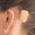 A New BAHA Hearing Aid... Without the Screw Implant
